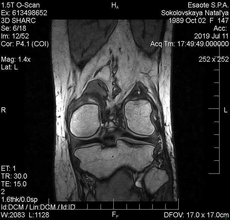 МРТ колінного суглоба