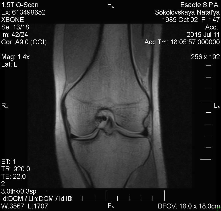 МРТ колінного суглоба