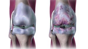 artralgiya-i-zdorovoe-koleno