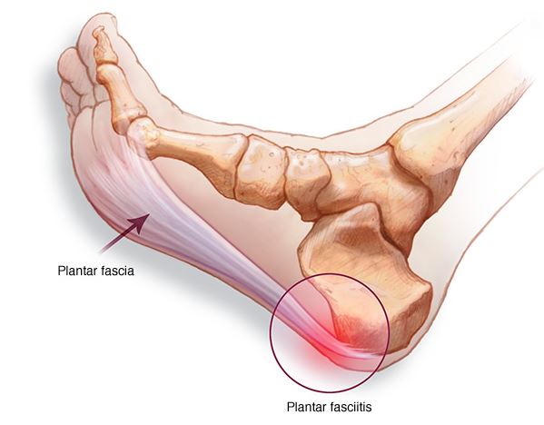 Подошвенный фасциит