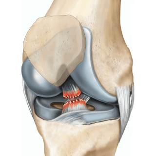 Тендинит коленного сустава – Институт лечения боли