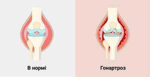 гонартроз, диагностика в Запорожье