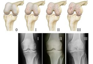 стадии гонартроза