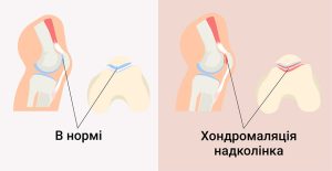 Хондромаляция надколенника - причины появления и симптомы.